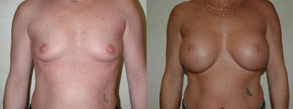 Breast Augmentation before and after photo by Dr. Richard A. Bartlett in Brookline, MA