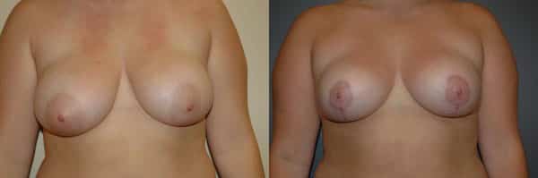 Breast Reduction before and after photo by Dr. Richard A. Bartlett in Brookline, MA