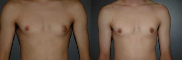 Gynecomastia (Male Breast Reduction) before and after photo by Dr. Richard A. Bartlett in Brookline, MA