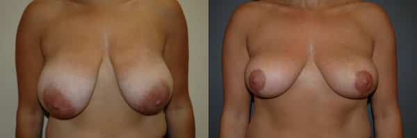 Breast Reduction before and after photo by Dr. Richard A. Bartlett in Brookline, MA