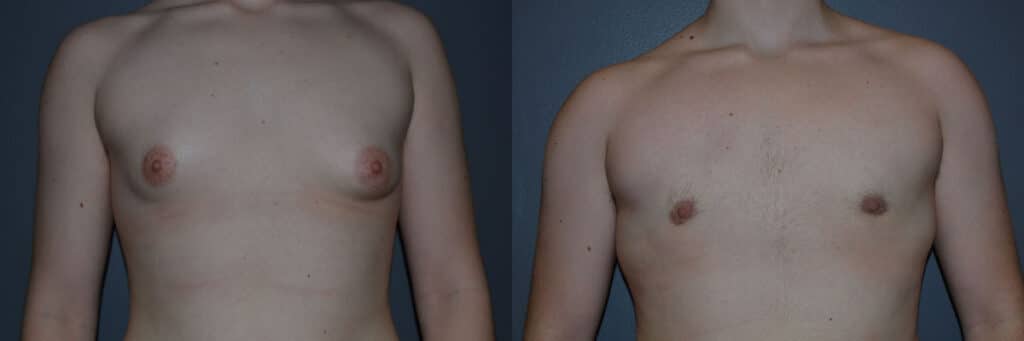 Gender Affirming Surgery before and after photo by Dr. Richard A. Bartlett in Brookline, MA