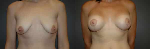 Breast Augmentation before and after photo by Dr. Richard A. Bartlett in Brookline, MA