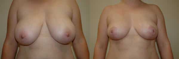 Breast Reduction before and after photo by Dr. Richard A. Bartlett in Brookline, MA