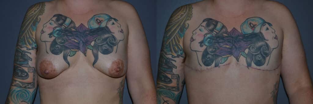 Gender Affirming Surgery before and after photo by Dr. Richard A. Bartlett in Brookline, MA