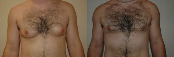 Gynecomastia (Male Breast Reduction) before and after photo by Dr. Richard A. Bartlett in Brookline, MA