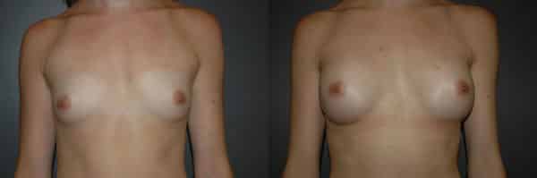 Breast Augmentation before and after photo by Dr. Richard A. Bartlett in Brookline, MA
