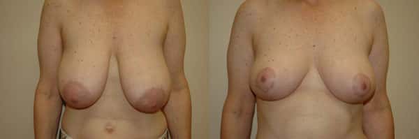 Breast Reduction before and after photo by Dr. Richard A. Bartlett in Brookline, MA