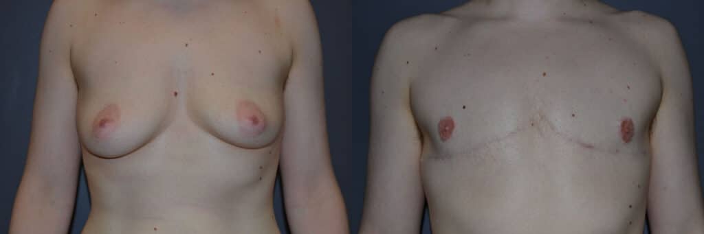 Gender Affirming Surgery before and after photo by Dr. Richard A. Bartlett in Brookline, MA
