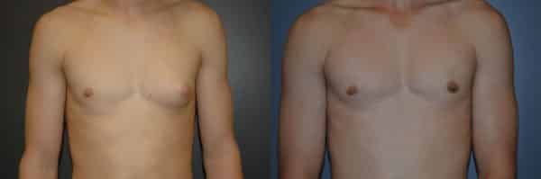 Gynecomastia (Male Breast Reduction) before and after photo by Dr. Richard A. Bartlett in Brookline, MA