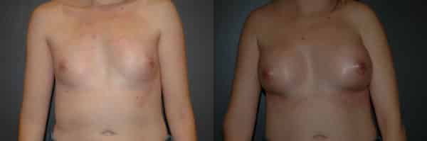 Breast Augmentation before and after photo by Dr. Richard A. Bartlett in Brookline, MA