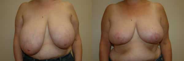 Breast Reduction before and after photo by Dr. Richard A. Bartlett in Brookline, MA