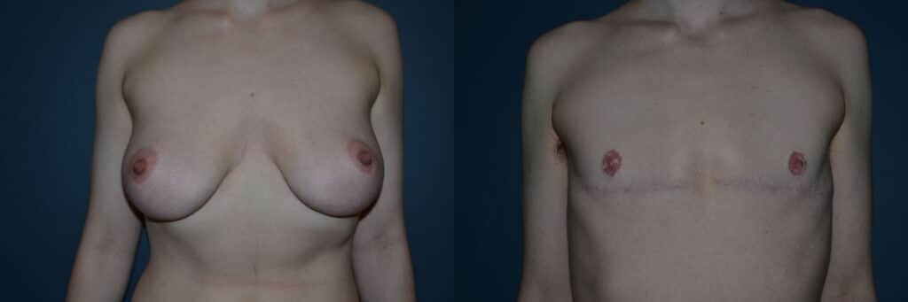 Gender Affirming Surgery before and after photo by Dr. Richard A. Bartlett in Brookline, MA