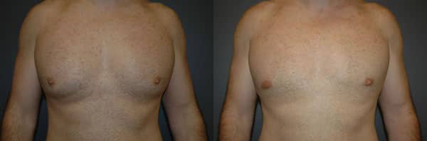 Gynecomastia (Male Breast Reduction) before and after photo by Dr. Richard A. Bartlett in Brookline, MA