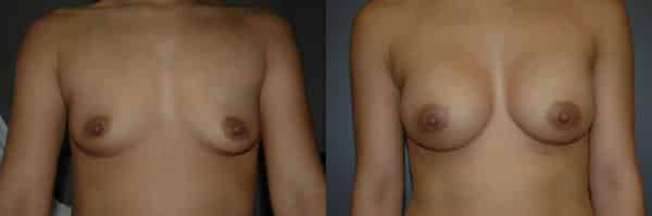 Breast Augmentation before and after photo by Dr. Richard A. Bartlett in Brookline, MA