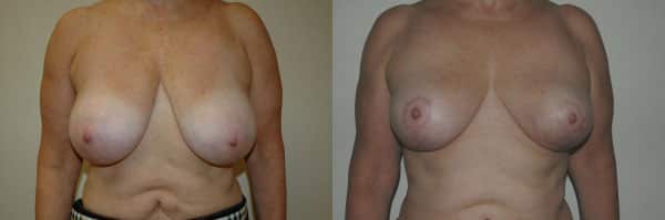 Breast Reduction before and after photo by Dr. Richard A. Bartlett in Brookline, MA