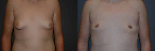Gynecomastia (Male Breast Reduction) before and after photo by Dr. Richard A. Bartlett in Brookline, MA