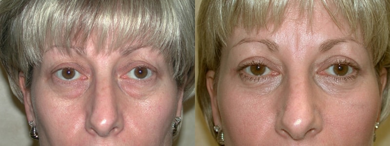 Blepharoplasty (Eyelid Surgery) before and after photo by Dr. Richard A. Bartlett in Brookline, MA