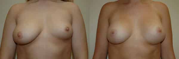 Breast Asymmetry before and after photo by Dr. Richard A. Bartlett in Brookline, MA