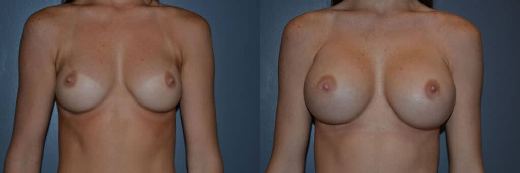 Breast Augmentation before and after photo by Dr. Richard A. Bartlett in Brookline, MA
