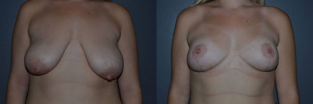 Breast Lift before and after photo by Dr. Richard A. Bartlett in Brookline, MA