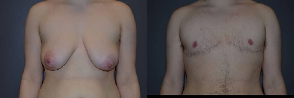 Gender Affirming Surgery before and after photo by Dr. Richard A. Bartlett in Brookline, MA