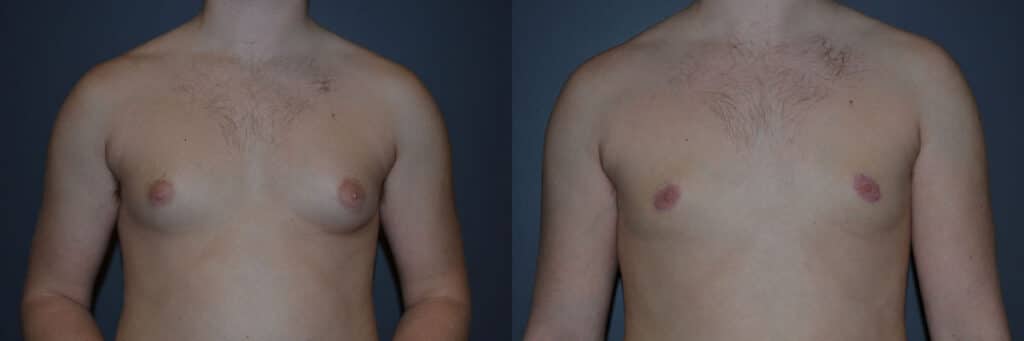 Gynecomastia (Male Breast Reduction) before and after photo by Dr. Richard A. Bartlett in Brookline, MA