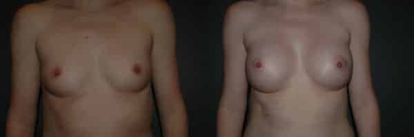 Breast Augmentation before and after photo by Dr. Richard A. Bartlett in Brookline, MA