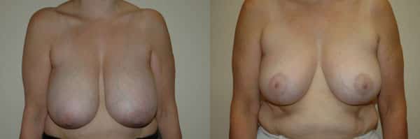 Breast Reduction before and after photo by Dr. Richard A. Bartlett in Brookline, MA