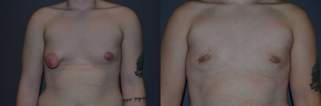 Gender Affirming Surgery before and after photo by Dr. Richard A. Bartlett in Brookline, MA