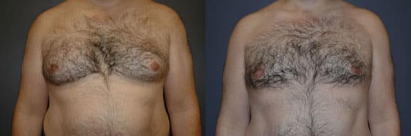 Gynecomastia (Male Breast Reduction) before and after photo by Dr. Richard A. Bartlett in Brookline, MA