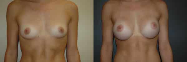 Breast Augmentation before and after photo by Dr. Richard A. Bartlett in Brookline, MA