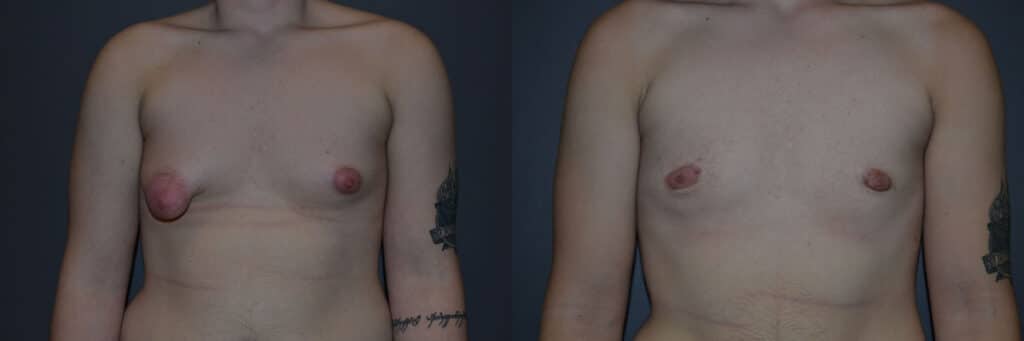 Gender Affirming Surgery before and after photo by Dr. Richard A. Bartlett in Brookline, MA