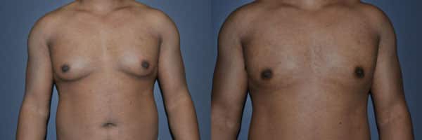 Gynecomastia (Male Breast Reduction) before and after photo by Dr. Richard A. Bartlett in Brookline, MA