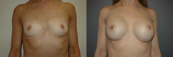 Breast Augmentation before and after photo by Dr. Richard A. Bartlett in Brookline, MA