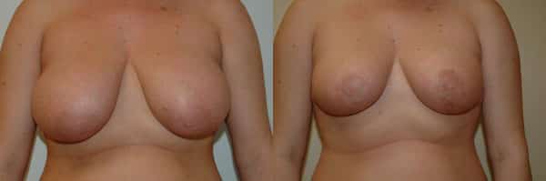 Breast Reduction before and after photo by Dr. Richard A. Bartlett in Brookline, MA