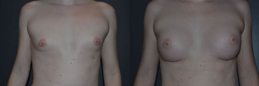 Gender Affirming Surgery before and after photo by Dr. Richard A. Bartlett in Brookline, MA