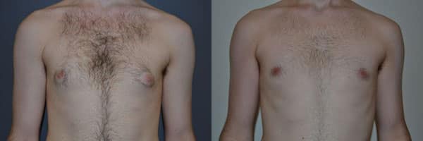 Gynecomastia (Male Breast Reduction) before and after photo by Dr. Richard A. Bartlett in Brookline, MA
