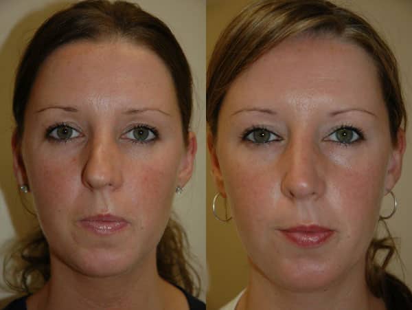 Rhinoplasty (Nose Surgery) before and after photo by Dr. Richard A. Bartlett in Brookline, MA