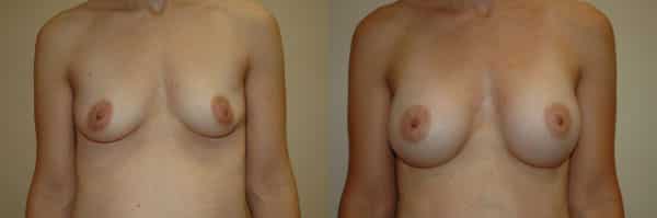 Breast Augmentation before and after photo by Dr. Richard A. Bartlett in Brookline, MA