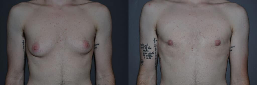 Gender Affirming Surgery before and after photo by Dr. Richard A. Bartlett in Brookline, MA