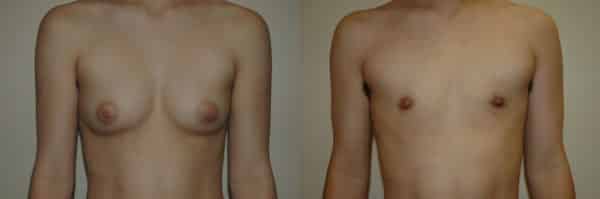 Gynecomastia (Male Breast Reduction) before and after photo by Dr. Richard A. Bartlett in Brookline, MA