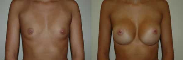 Breast Augmentation before and after photo by Dr. Richard A. Bartlett in Brookline, MA