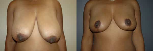 Breast Reduction before and after photo by Dr. Richard A. Bartlett in Brookline, MA