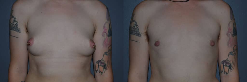 Gender Affirming Surgery before and after photo by Dr. Richard A. Bartlett in Brookline, MA