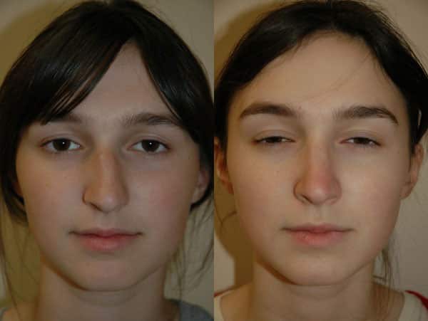 Rhinoplasty (Nose Surgery) before and after photo by Dr. Richard A. Bartlett in Brookline, MA
