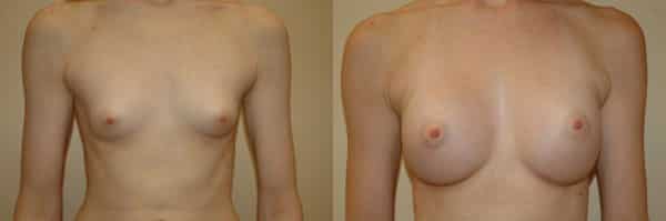 Breast Augmentation before and after photo by Dr. Richard A. Bartlett in Brookline, MA