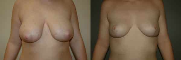 Breast Reduction before and after photo by Dr. Richard A. Bartlett in Brookline, MA