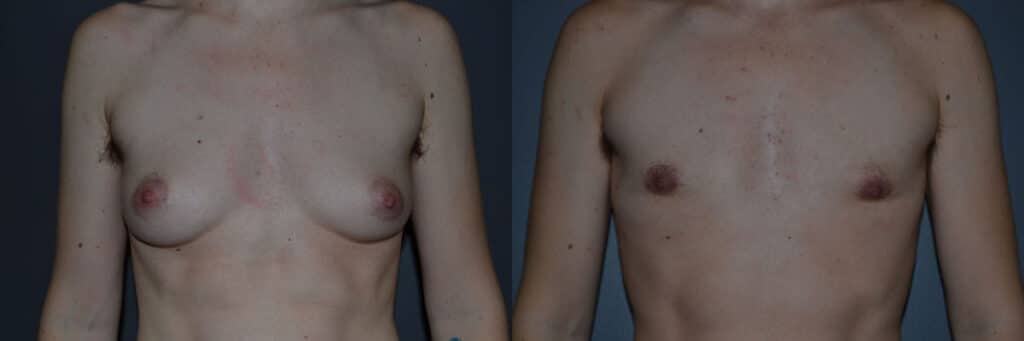 Gender Affirming Surgery before and after photo by Dr. Richard A. Bartlett in Brookline, MA