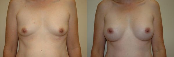 Breast Augmentation before and after photo by Dr. Richard A. Bartlett in Brookline, MA