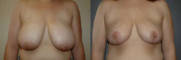 Breast Reduction before and after photo by Dr. Richard A. Bartlett in Brookline, MA